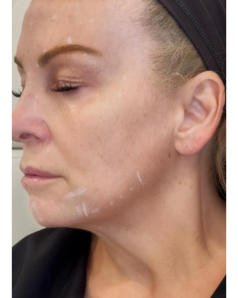 Nefertiti Lift & Platysmal Band Treatment